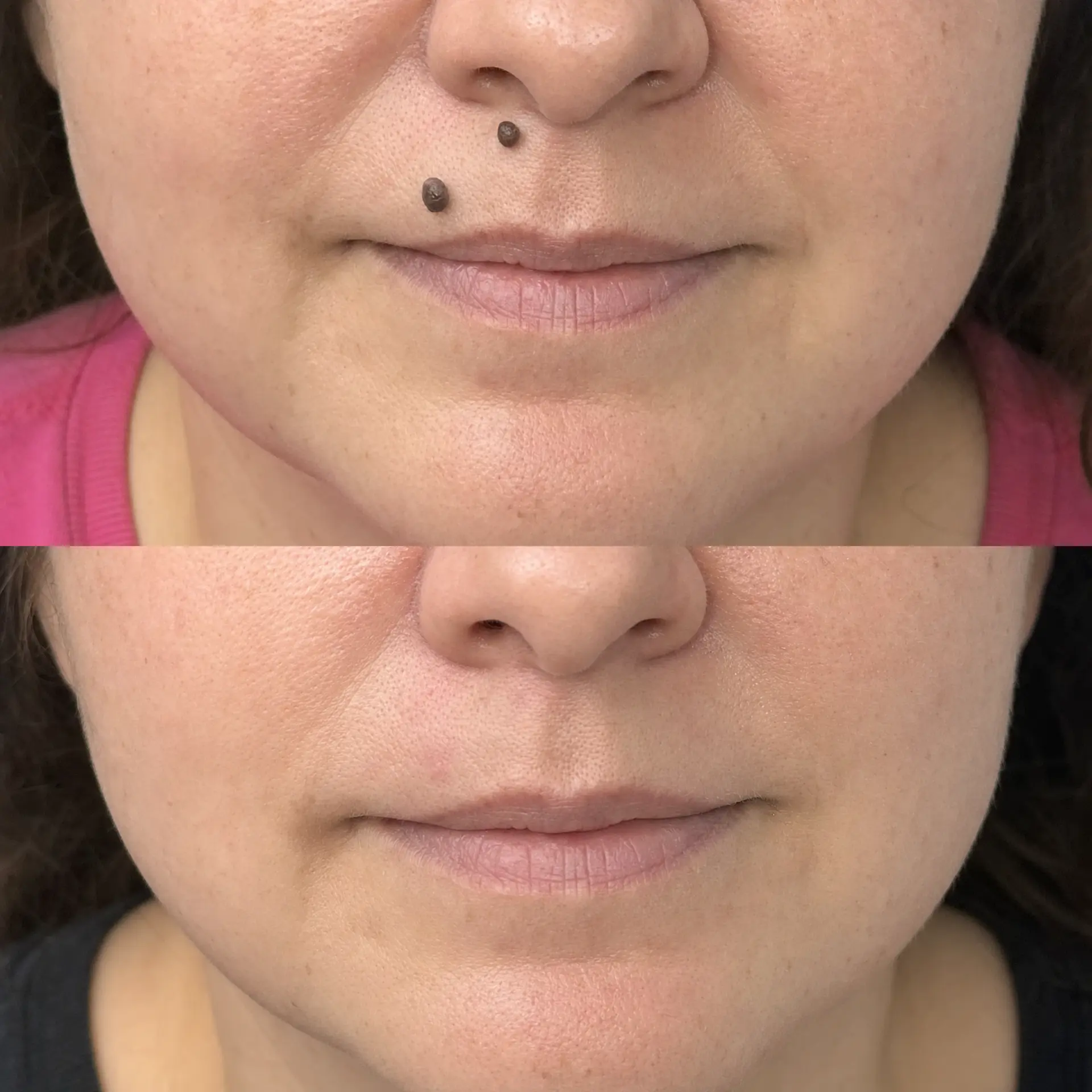 Before and after mole removal on the face